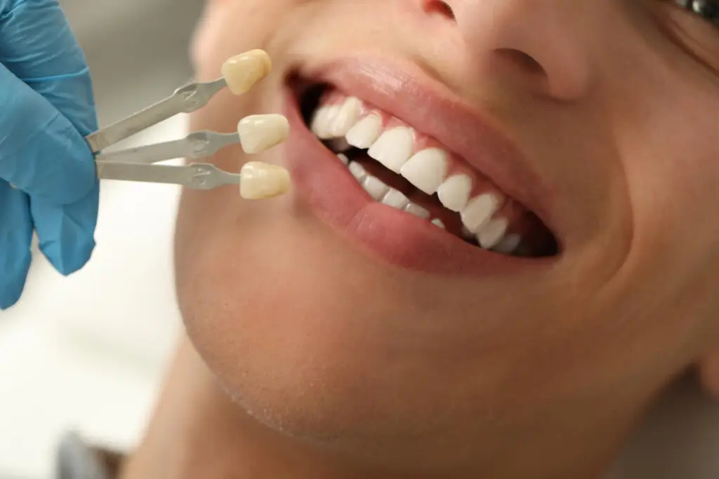 Dental veneers being matched to a patient's teeth by a dentist for a natural-looking smile.