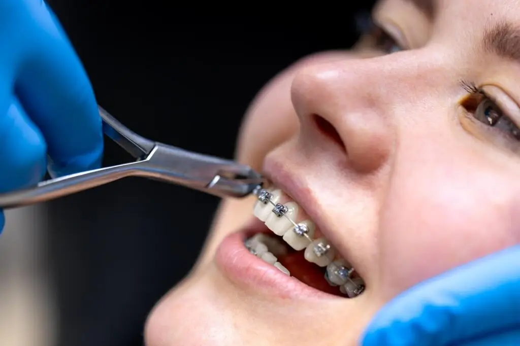Close-up of a dentist adjusting braces on a patient's teeth during an orthodontic treatment procedure.